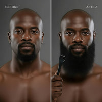 540 Needles for Facial Body Hair Growth Derma Roller for Skin Beard 0.2Mm 0.25Mm 0.3Mm Needle Micro Face Roll Tool